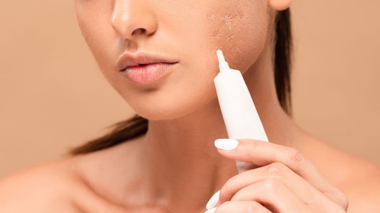 คู่มือการซื้อครีมรอยแผลเป็น